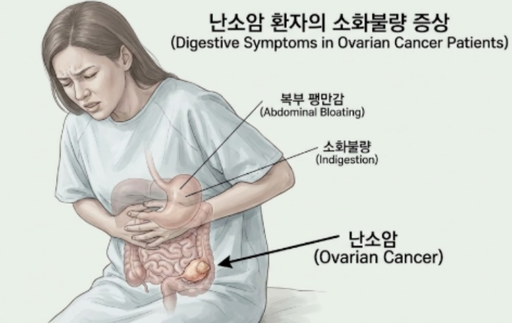 난소암 초기증상